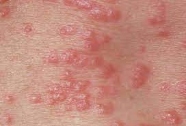 How to Treat Mattress for Scabies